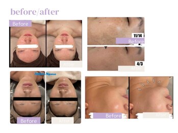 エミット(emit.)/即効リフトアップ