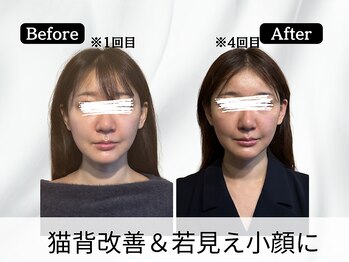 ハリユナイテッド 原宿鍼灸 整体院(HALI UNITED)/猫背改善&若見え小顔に!