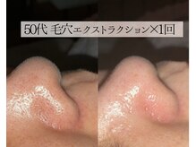 ル シーニュ/毛穴エクストラクション