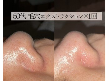 ル シーニュ/毛穴エクストラクション