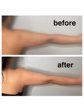 ブルースター(BLUE STAR)/オンダリフト【二の腕振袖撃退】