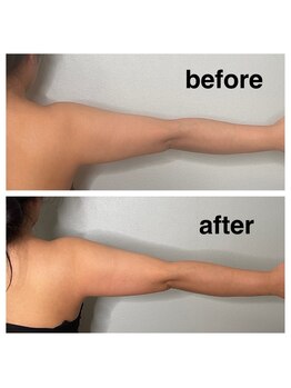 ブルースター(BLUE STAR)/オンダリフト【二の腕振袖撃退】