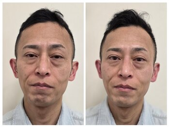 アンジェリーナ/50代フェイシャルエステ