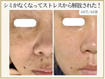 ポモナ 横浜馬車道店(Pomona)/頬の大きなシミと口周りシミ悩み