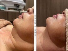 ナスサロの雰囲気（【脂肪分解剤レモンボトル ¥9,800】芸能人も愛用！二重顎撃退！）