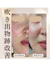 スリーピングビューティー(Sleeping Beauty)/ニキビ、肌荒れ改善