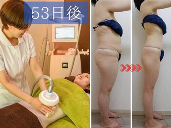 デイスパ ヴィータの写真/【その体はむくみ脂肪】女性の肥満は8割がむくみ脂肪が原因!強制的にむくみ排除でスッキリ¥5,500
