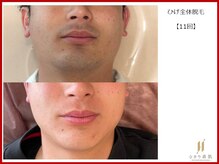 ひかり素肌/ひげ脱毛11回