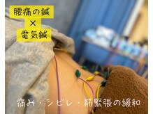 S鍼灸整骨院の雰囲気（腰痛の鍼(電気鍼））