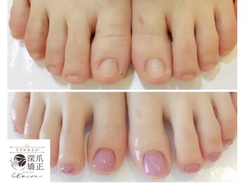 トイロ(toiro)の写真/足元の深爪矯正で《素足にも自信をもてる仕上がりに！》結果重視でサポートします♪