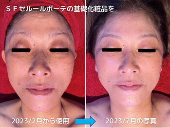 ファルファラ(farfara)/天然ハーブピーリング