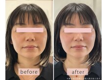 いとう鍼灸整体院 代官山恵比寿/美容鍼ビフォーアフター