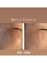 ジュエル(jewel)/低周波シミケア