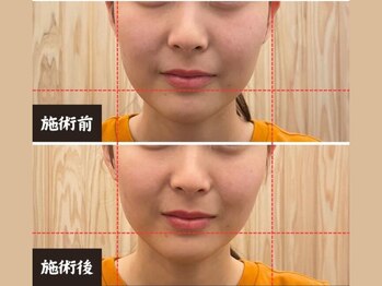 ととのえ処 良久庵/美容鍼