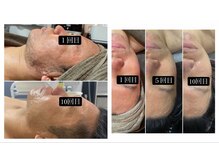 サマラボ 三軒茶屋(Sama Labo)/Before→After(毛穴、凹凸)