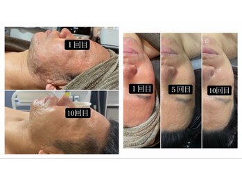 サマラボ 三軒茶屋(Sama Labo)/Before→After(毛穴、凹凸)