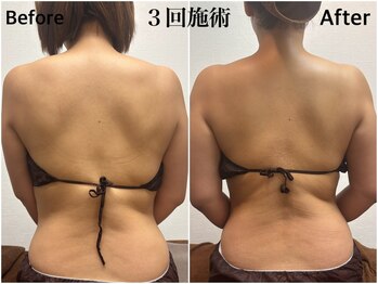 ラ ブリエ(La Briller)/背中リンパマッサージでスッキリ