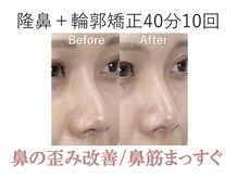 ラプリシュシュ 岡山店(Raplit)/ 隆鼻＋輪郭矯正40分10回