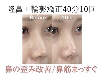 ラプリシュシュ 岡山店(Raplit)/ 隆鼻+輪郭矯正40分10回