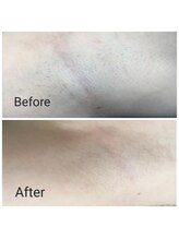 サロン ピューパ(Salon pupa)/女性脇脱毛　before→after