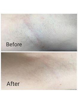 サロン ピューパ(Salon pupa)/女性脇脱毛　before→after