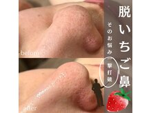 サロンドゥルシエル/いちご鼻解消