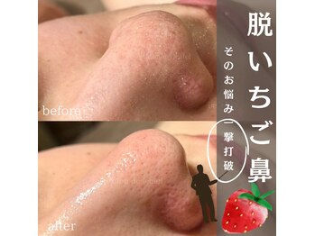 サロンドゥルシエル/いちご鼻解消