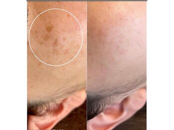 ソイ(Soi)/平均3回の施術で効果を実感