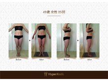 ハンズ鍼灸接骨院小牧院 美容整体ハンズ(美容整体hands)/ハイパーナイフ before after