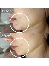 ホワイトアクア 鳳店(WHITE AQUA)/ハーブピーリング/毛穴/大阪/鳳