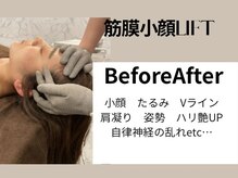 ビノスビューティー(vinos.beauty)/お客様症例　小顔/毛穴/たるみ