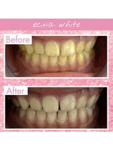 エクシアホワイトニング 稲沢店/お客様ビフォーアフター