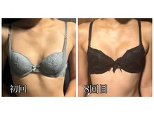 リルマコ/バスト症例写真
