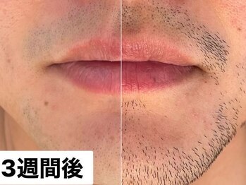 ルナステラ 七尾店/LEDローズ脱毛