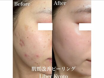 エステティック リベル キョウト 京都駅前店(Esthetic Liber Kyoto)/肌質改善ピーリング