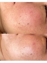 メリア(Mellia)/角育ハーブトリートメント