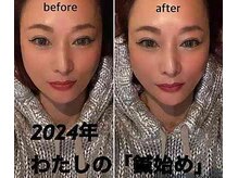 ルディア 堀江店(ledia)/美容鍼歴16年50歳代メンテナンス