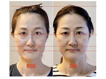 小顔22 ボルティ 本店(Bolty)/小顔矯正2回目