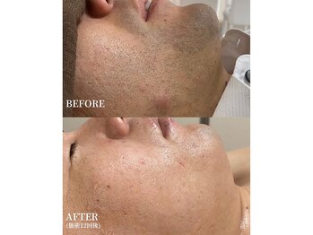 エースビューティーサロン 蒲郡店(ACE. beauty salon)/機械の効果を見てください