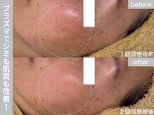 サロン ビュー(salon view)/30代女性〈シミ悩み〉　