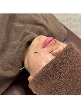 新船橋オレンジ鍼灸整体院/美容鍼も人気です！