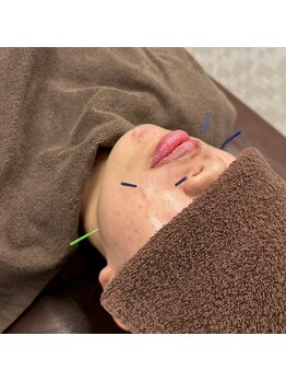 新船橋オレンジ鍼灸整体院/美容鍼も人気です!