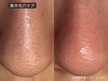 ジュパール(je pars)/毛穴エクストラクション
