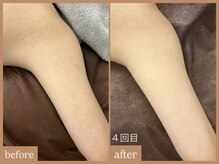 リムーン 岡崎(Re'moon)/REVI ハーブピーリング　二の腕