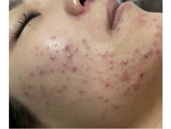 リベル 名古屋(Lebelle:)/ハーブピーリング 名古屋