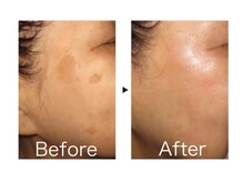 デアルーチェ(DEA LUCE)/シミ改善ピーリングフェイシャル