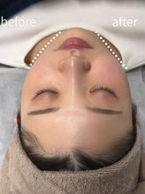 小顔専門店Lift(リフト)下北沢/小顔専門店Lift｜Before After