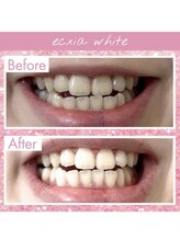 エクシアホワイトニング 天王寺店/ホワイトニングビフォーアフター