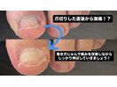 爪切り直後から激痛！？