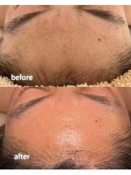 リルビー(Lilby)の写真/感動の艶肌へ。フェイシャルワックスで毛穴汚れや産毛をスッキリ。施術直後から驚きのつるすべ肌に！